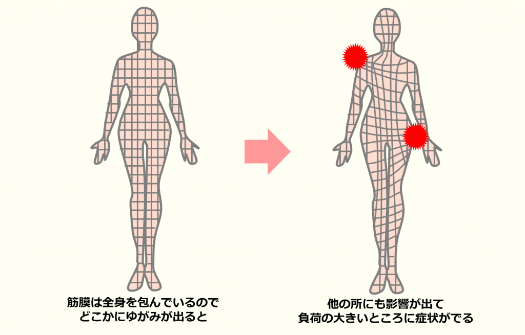 筋膜は全身を包んでいるため、どこかにゆがみが出ると他の部分にも影響が出て、負荷の大きいところに症状が出る図