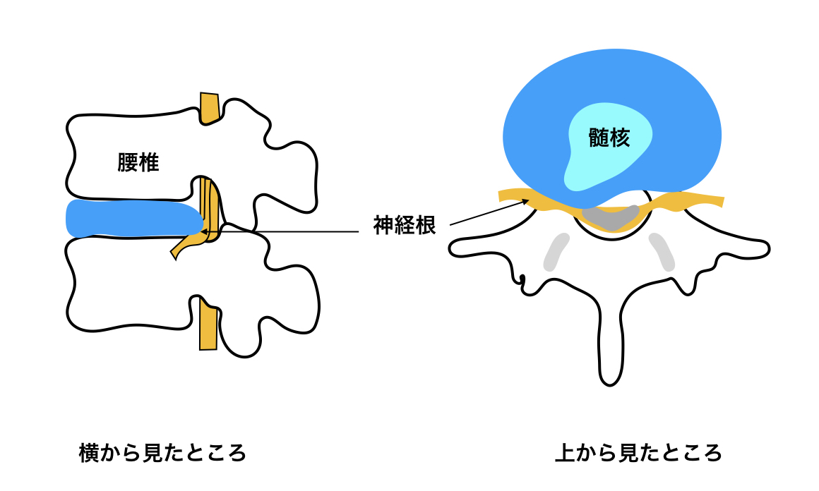 腰椎椎間板ヘルニアの図
