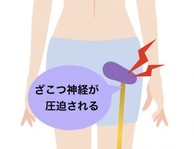 坐骨神経が圧迫されるイメージ図